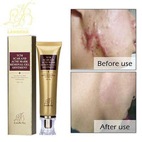 Wisdompark Acne Scar Removal Cream Skin Repair Face Cream Acne Spots Acne Treatment Blackhead - Eva Curly